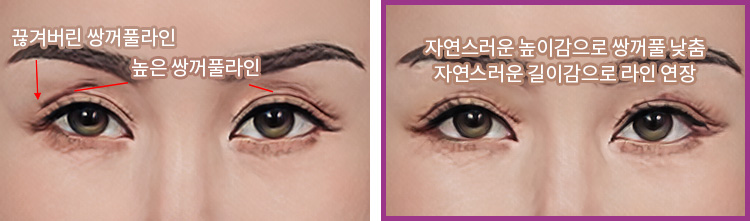 끊겨버린 쌍꺼풀라인, 높은 쌍꺼풀라인(좌) / 자연스러운 높이감으로 쌍꺼풀 낮춤, 자연스러운 길이감으로 라인 연장(우)