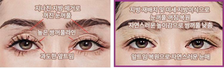 지나친 지방 제거로 꺼진 눈꺼풀, 높은 쌍꺼풀라인, 과도한 앞트임(좌) / 지방 재배치 및 미세 지방이식으로 눈꺼풀 꺼짐 복원, 자연스러운 높이감으로 쌍꺼풀 낮춤, 앞트임 복원으로 자연스러운 눈매(우)