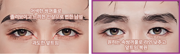 어색한 쌍꺼풀로 졸려보이고 느끼한 인상으로 변한 남성, 과도한 앞트임(좌) / 원하는 속쌍꺼풀로 라인 낮추고 앞트임 복원(우)