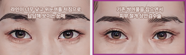 라인이 너무 낮고 위눈꺼풀 처짐으로 답답해 보이는 눈매(좌) / 기존 쌍꺼풀을 잡으면서 피부 절개 상안검수술(우)