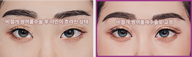 비절개 쌍꺼풀수술 후 라인이 흐려진 상태(좌) / 비절개 쌍꺼풀재수술로 교정(우)