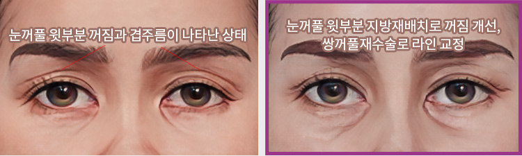 눈꺼풀 윗부분 꺼짐과 겹주름이 나타난 상태(좌) / 눈꺼풀 윗부분 지방재배치로 꺼짐 개선, 쌍꺼풀재수술로 라인 교정(우)