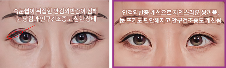 속눈썹이 뒤집힌 안검외반증이 심해 눈 당김과 안구건조증도 심한 상태(좌) / 안검외반증 개선으로 자연스러운 쌍꺼풀, 눈 뜨기도 편안해지고 안구건조증도 개선됨(우)