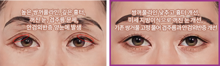 높은 쌍꺼풀라인, 깊은 흉터, 꺼진 눈, 겹주름 문제, 안검외반증 양눈에 발생(좌) / 쌍꺼풀라인 낮추고 흉터 개선, 미세 지방이식으로 꺼진 눈 개선, 기존 쌍거풀 고정 풀어 겹주름과 안검외반증 개선(우)