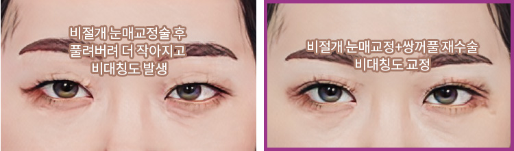 비절개 눈매교정술 후 풀려버려 더 작아지고 비대칭도 발생(좌) / 비절개 눈매교정+쌍꺼풀 재수술 비대칭도 교정(우)