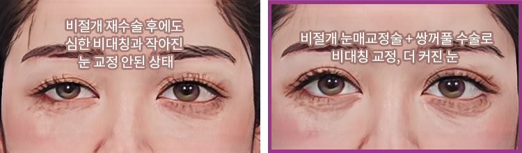 비절개 재수술 후에도 심한 비대칭과 작아진 눈 교정 안된 상태(좌) / 비절개 눈매교정술 + 쌍꺼풀 수술로 비대칭 교정, 더 커진 눈(우)