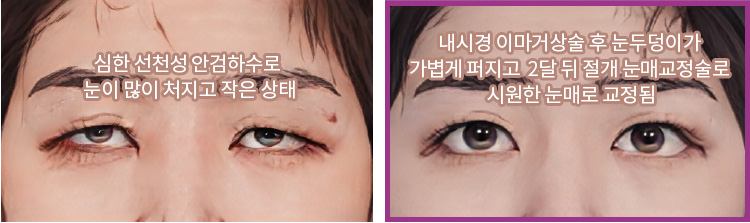 심한 선천성 안검하수로 눈이 많이 처지고 작은 상태(좌) / 내시경 이마거상술 후 눈두덩이가 가볍게 퍼지고 2달 뒤 절개 눈매교정술로 시원한 눈매로 교정됨(우)
