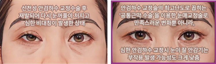 선천성 안검하수 교정수술 후 재발되어 다시 눈꺼풀이 처지고 심한 비대칭이 발생한 상태(좌) / 안검하수 교정술의 최고난도로 꼽히는 ‘공통근막 수술’을 이용한 눈매교정술로 만족스러운 변화뿐 아니라, 심한 안검하수 교정시 눈이 잘 안감기는 부작용 발생 가능성도 크게 낮춤(우)