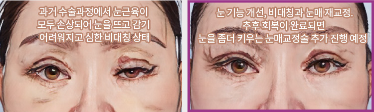 과거 수술과정에서 눈근육이 모두 손상되어 눈을 뜨고 감기 어려워지고 심한 비대칭 상태(좌) / 눈 기능 개선, 비대칭과 눈매 재교정. 추후 회복이 완료되면 눈을 좀더 키우는 눈매교정술 추가 진행 예정(우)