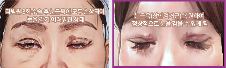 타병원 3회 수술 후 눈근육이 모두 손상되어 눈을 감기 어려워진 상태(좌) / 눈근육(상안검거근) 복원하여 정상적으로 눈을 감을 수 있게 됨(우)