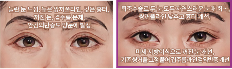 속눈썹이 뒤집힌 안검외반증이 심해 눈 당김과 안구건조증도 심한 상태(좌) / 안검외반증 개선으로 자연스러운 쌍꺼풀, 눈 뜨기도 편안해지고 안구건조증도 개선됨(우)