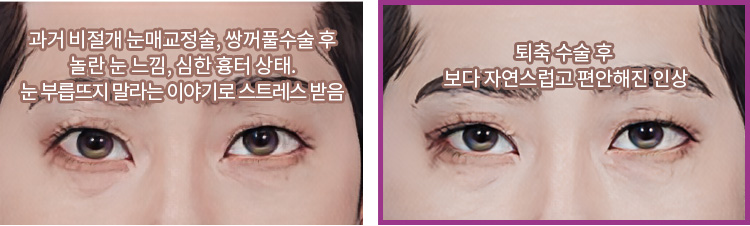 과거 비절개 눈매교정술, 쌍꺼풀수술 후 놀란 눈 느낌, 심한 흉터 상태. 눈 부릅뜨지 말라는 이야기로 스트레스 받음(좌) / 퇴축 수술 후 보다 자연스럽고 편안해진 인상(우)