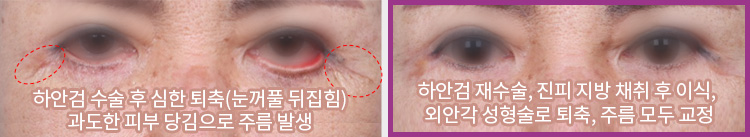 하안검 수술 후 심한 퇴축(눈꺼풀 뒤집힘) 과도한 피부 당김으로 주름 발생(좌) / 하안검 재수술, 진피 지방 채취 후 이식, 외안각 성형술로 퇴축, 주름 모두 교정(우)