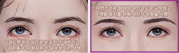 과도한 뒤트임으로 눈꼬리가 내려가고 검은동자 뒤 흰자위가 많이 보이는 상태(좌) / 자연스러운 형태의 외안각으로 교정하고 재발 방지를 위해 외안각 성형술 시행(우)