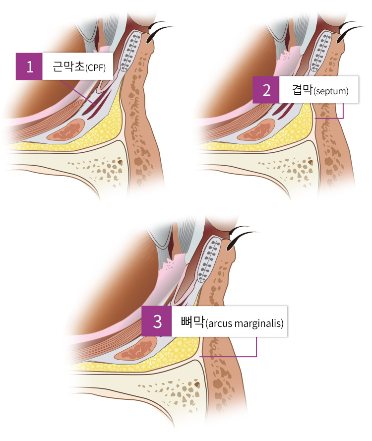 1. 근막초(CPF) / 2. 겹막(septurm) / 3. 뼈막(arcus marginalis)