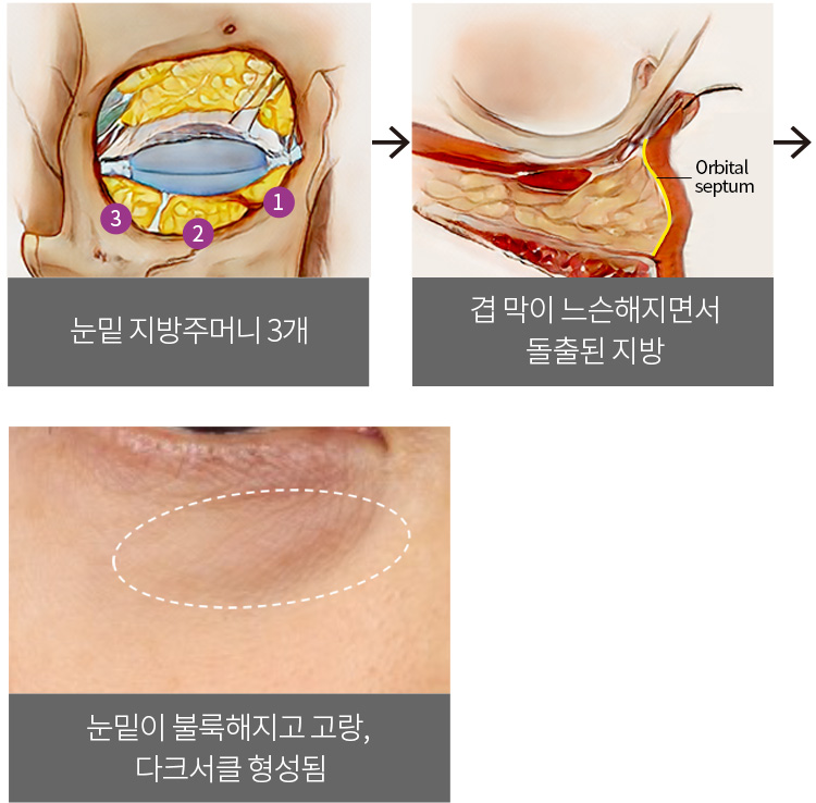 눈밑 지방주머니 3개 > 겹 막이 느슨해지면서 돌출된 지방 > 눈밑이 불룩해지고 고랑, 다크서클 형성됨
