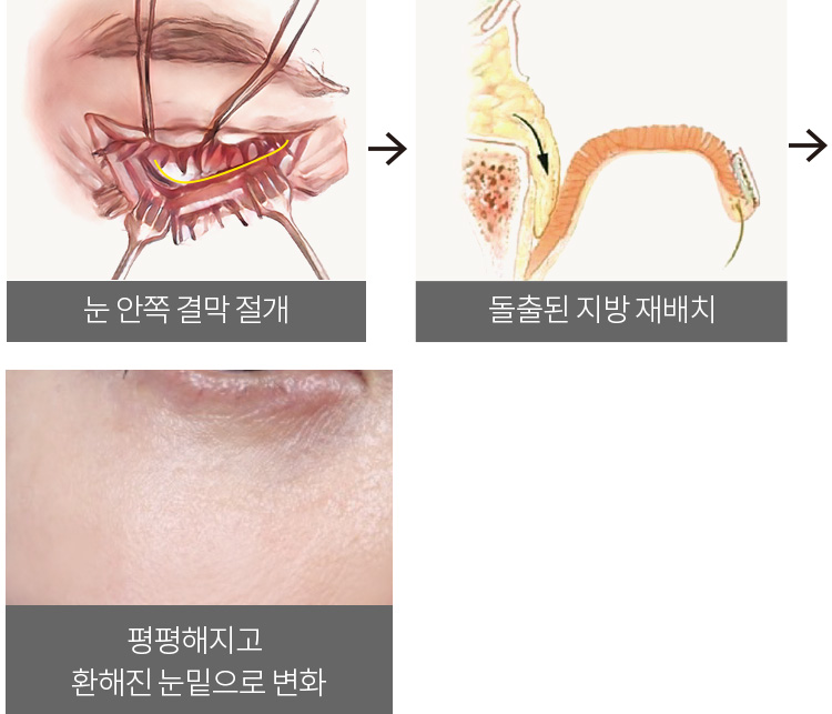 눈 안쪽 결막 절개 > 돌출된 지방 재배치 > 평평해지고 환해진 눈밑으로 변화