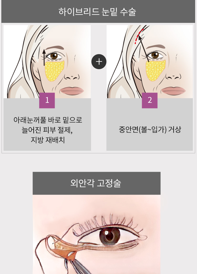 하이브리드 눈밑 수술 : 1.아래눈꺼풀 바로 밑으로 늘어진 피부 절제, 지방 재배치 + 2.중안면(볼~입가) 거상(좌) / 외안각 고정술(우)