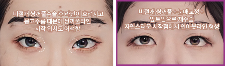 비절개 쌍꺼풀수술 후 라인이 흐려지고 몽고주름 때문에 쌍꺼풀라인 시작 위치도 어색함(좌) / 비절개 쌍꺼풀+눈매교정+앞트임으로 재수술 자연스러운 시작점에서 인아웃라인 형성(우)
