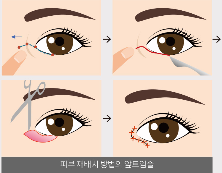 피부 재배치 방법의 앞트임