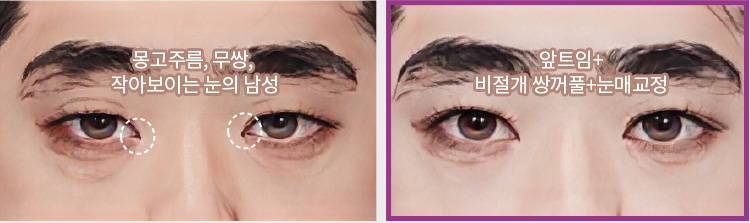 몽고주름, 무쌍, 작아보이는 눈의 남성(좌) / 앞트임+비절개 쌍꺼풀+눈매교정(우)
