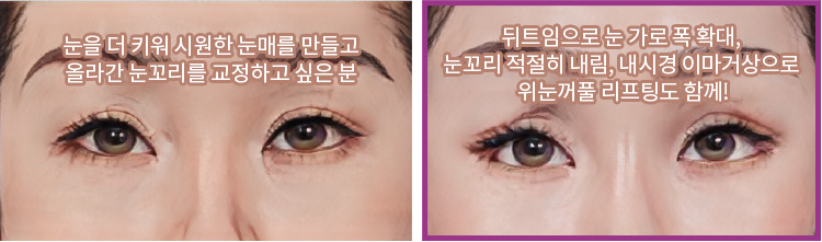 눈을 더 키워 시원한 눈매를 만들고 올라간 눈꼬리를 교정하고 싶은 분(좌) / 뒤트임으로 눈 가로 폭 확대, 눈꼬리 적절히 내림, 내시경 이마거상으로 위눈꺼풀 리프팅도 함께!(우)