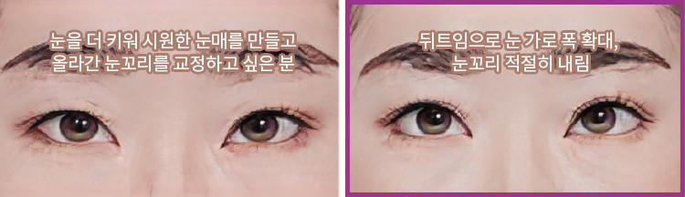 눈을 더 키워 시원한 눈매를 만들고 올라간 눈꼬리를 교정하고 싶은 분(좌) / 뒤트임으로 눈 가로 폭 확대, 눈꼬리 적절히 내림(우)