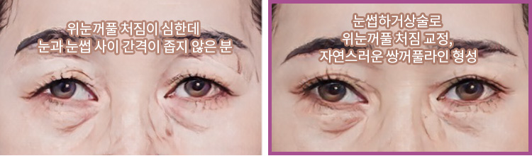 위눈꺼풀 처짐이 심한데 눈과 눈썹 사이 간격이 좁지 않은 분(좌) / 눈썹하거상술로 위눈꺼풀 처짐 교정, 자연스러운 쌍꺼풀라인 형성(우)