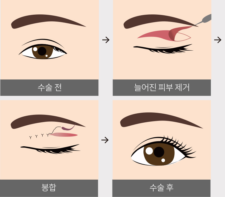 수술 전 > 늘어진 피부 제거 > 봉합 > 수술 후