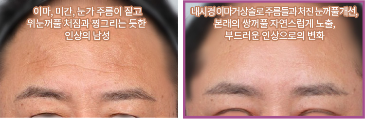이마, 미간, 눈가 주름이 짙고 위눈꺼풀 처짐과 찡그리는 듯한 인상의 남성(좌) / 내시경 이마거상술로 주름들과 처진 눈꺼풀 개선, 본래의 쌍꺼풀 자연스럽게 노출, 부드러운 인상으로의 변화(우)