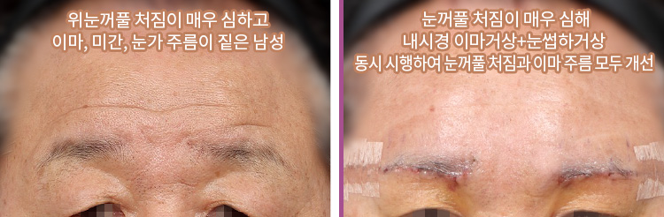 위눈꺼풀 처짐이 매우 심하고 이마, 미간, 눈가 주름이 짙은 남성(좌) / 눈꺼풀 처짐이 매우 심해 내시경 이마거상+눈썹하거상 동시 시행하여 눈꺼풀 처짐과 이마 주름 모두 개선(우)