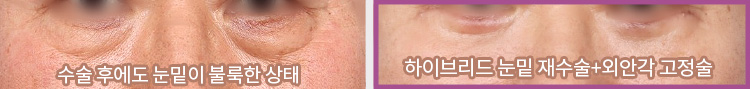 수술 후에도 눈밑이 불룩한 상태(좌) / 하이브리드 눈밑 재수술+외안각 고정술(우)