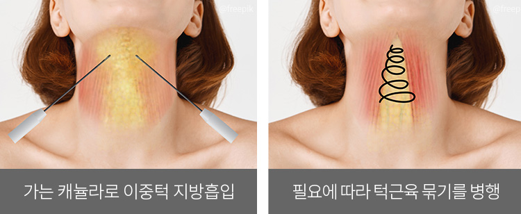 가는 캐뉼라로 이중턱 지방흡입(좌) / 필요에 따라 턱근육 묶기를 병행합니다.(우)