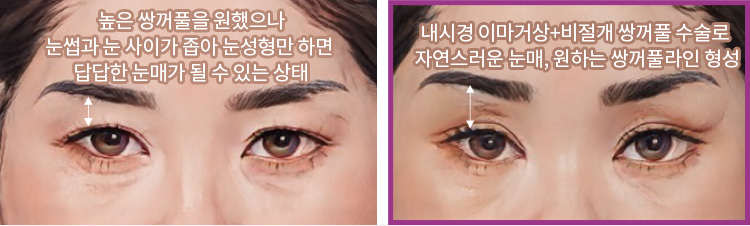 높은 쌍꺼풀을 원했으나 눈썹과 눈 사이가 좁아 눈성형만 하면 답답한 눈매가 될 수 있는 상태(좌) / 내시경 이마거상+비절개 쌍꺼풀 수술로 자연스러운 눈매, 원하는 쌍꺼풀라인 형성(우)