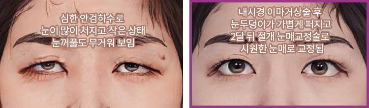 심한 안검하수로 눈이 많이 처지고 작은 상태. 눈꺼풀도 무거워 보임(좌) / 내시경 이마거상술 후 눈두덩이가 가볍게 퍼지고 2달 뒤 절개 눈매교정술로 시원한 눈매로 교정됨(우)
