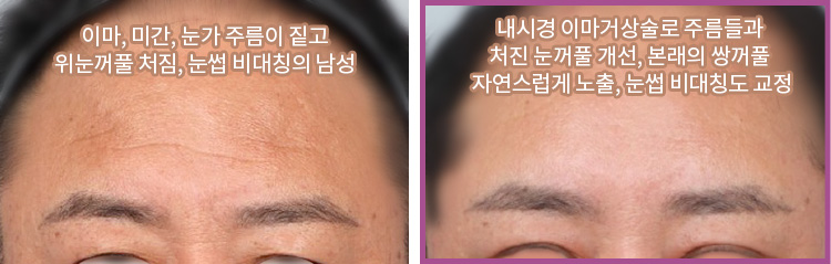 이마, 미간, 눈가 주름이 짙고 위눈꺼풀 처짐, 눈썹 비대칭의 남성(좌) / 내시경 이마거상술로 주름들과 처진 눈꺼풀 개선, 본래의 쌍꺼풀 자연스럽게 노출, 눈썹 비대칭도 교정(우)