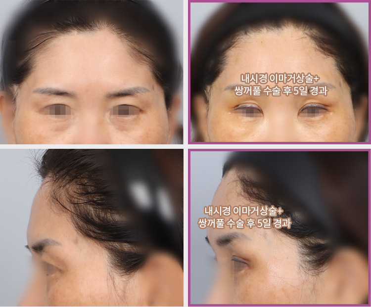 내시경 이마거상술+쌍꺼풀 수술 후 5일 경과(우상) / 내시경 이마거상술+쌍꺼풀 수술 후 5일 경과(우하)