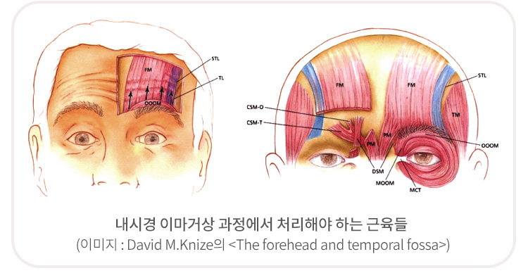 내시경 이마거상 과정에서 처리해야 하는 근육들 (이미지 : David M.Knize의 <The forehead and temporal fossa>)