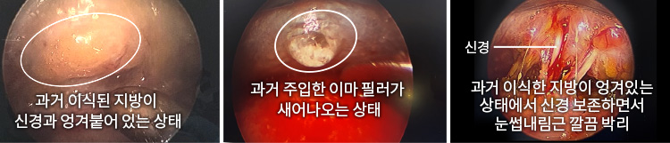 과거 이식된 지방이 신경과 엉겨붙어 있는 상태(좌) / 과거 주입한 이마 필러가 새어나오는 상태(중) / 과거 이식한 지방이 엉겨있는 상태에서 신경 보존하면서 눈썹내림근 깔끔 박리(우)
