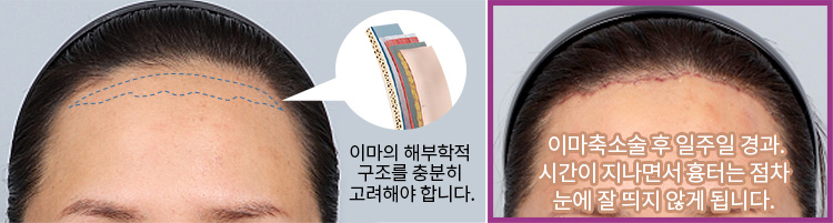 이마의 해부학적 구조를 충분히 고려해야 합니다.(좌) / 이마축소술 후 일주일 경과. 시간이 지나면서 흉터는 점차 눈에 잘 띄지 않게 됩니다.(우)