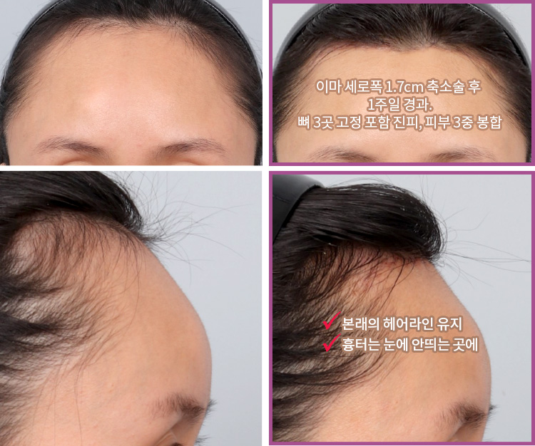 이마 세로폭 1.7cm 축소술 후 1주일 경과. 뼈 3곳 고정 포함 진피, 피부 3중 봉합(우상) / 본래의 헤어라인 유지. 흉터는 눈에 안띄는 곳에(우하)