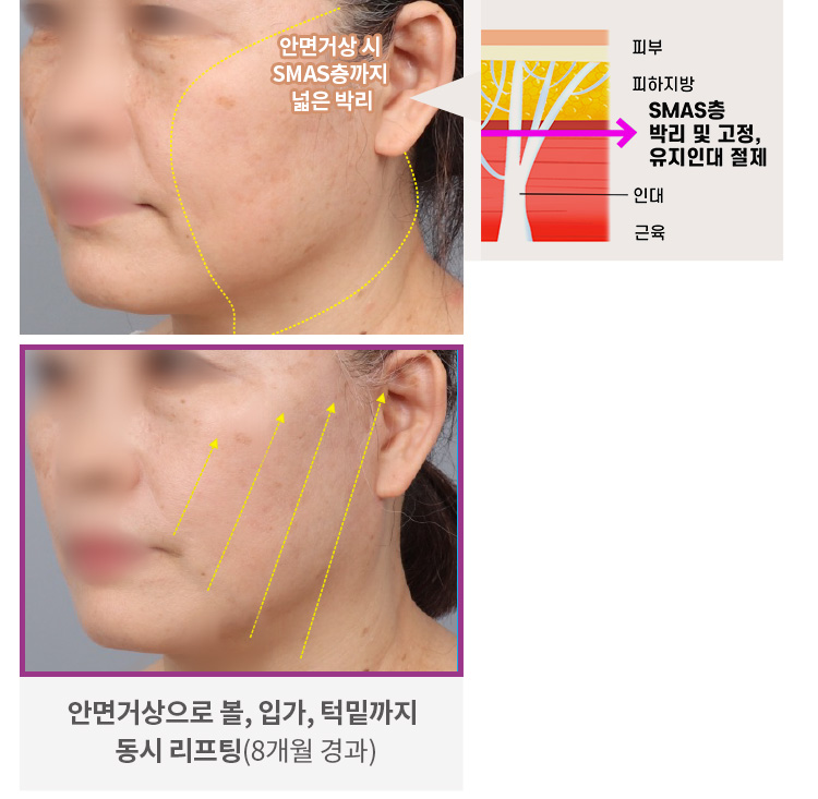안면거상 시 SMAS층까지 넓은 박리(상) / 안면거상으로 볼, 입가, 턱밑까지 동시 리프팅(8개월 경과)(우)