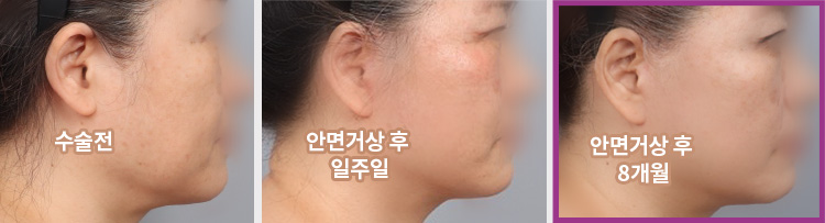 수술전 > 안면거상 후 일주일 > 안면거상 후 8개월